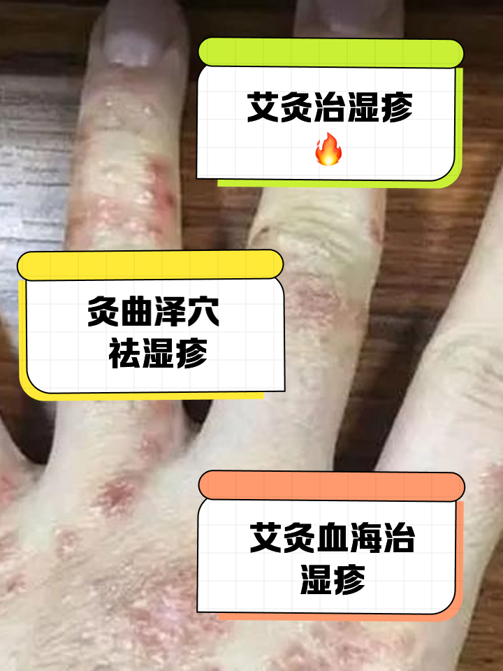 湿毒最佳治疗方法是什么