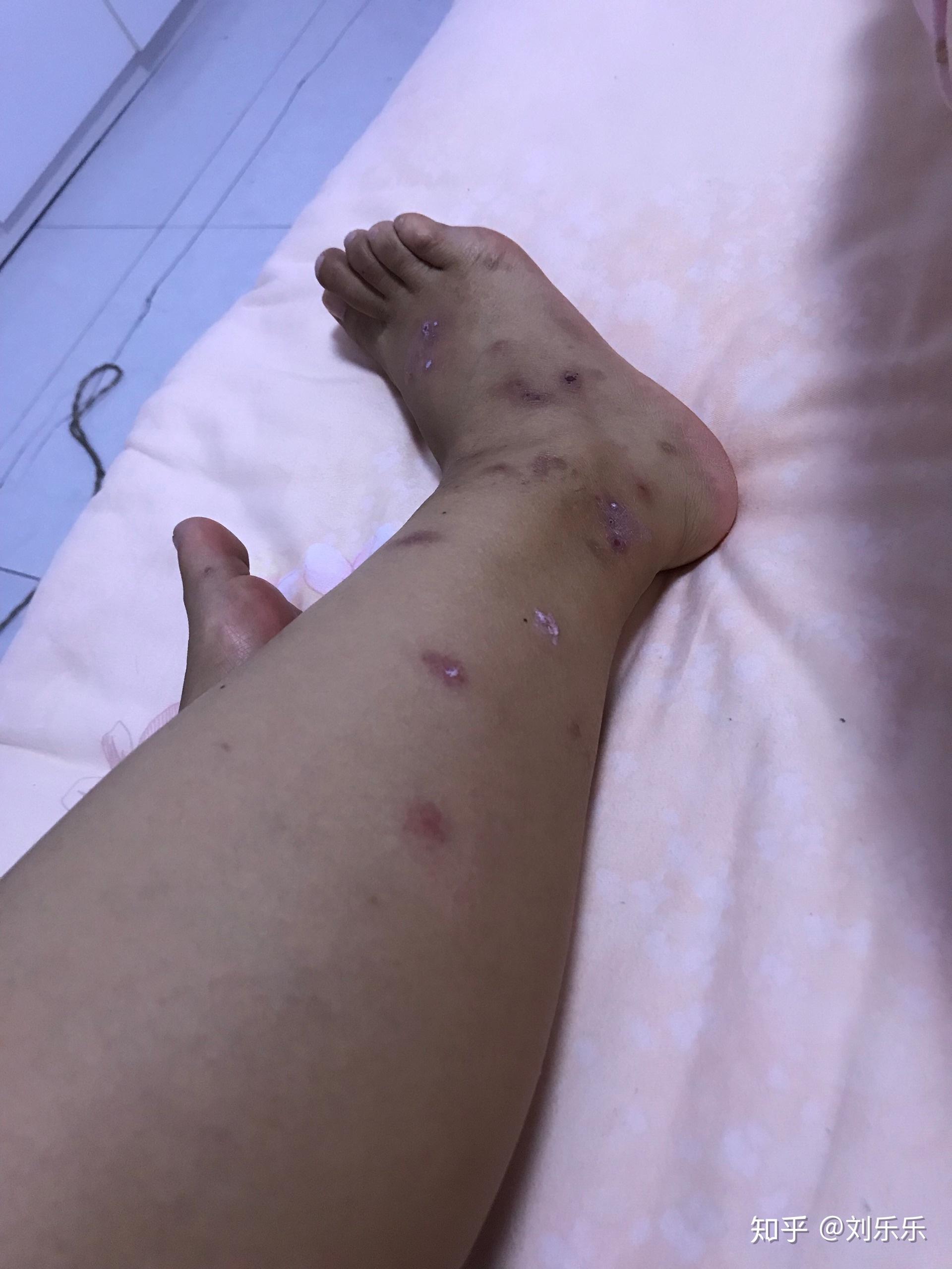 被跳蚤咬的症状图片有哪些