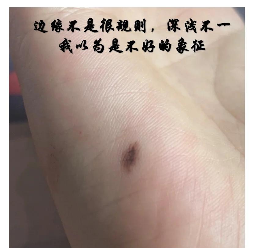 手掌心有痣代表什么意思