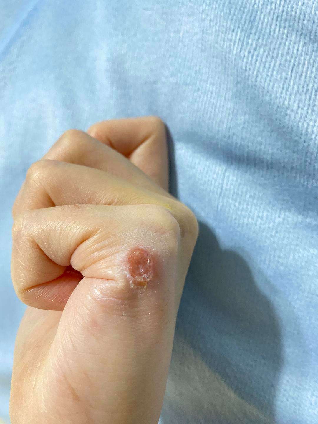 人得了猫癣初期症状图